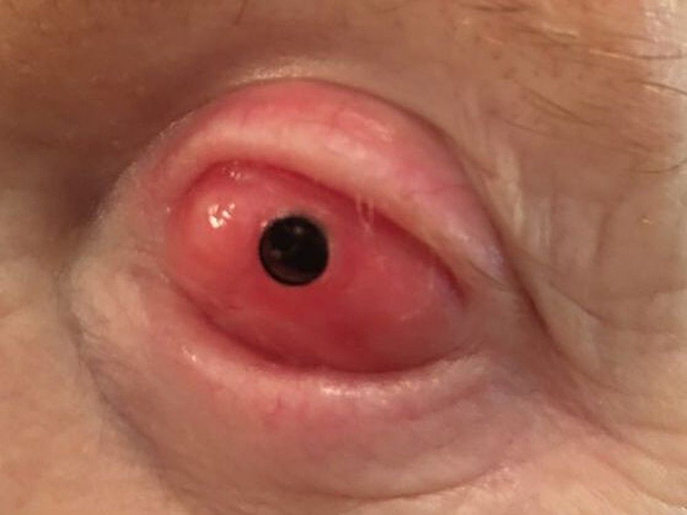  A patient’s eye after the surgery.