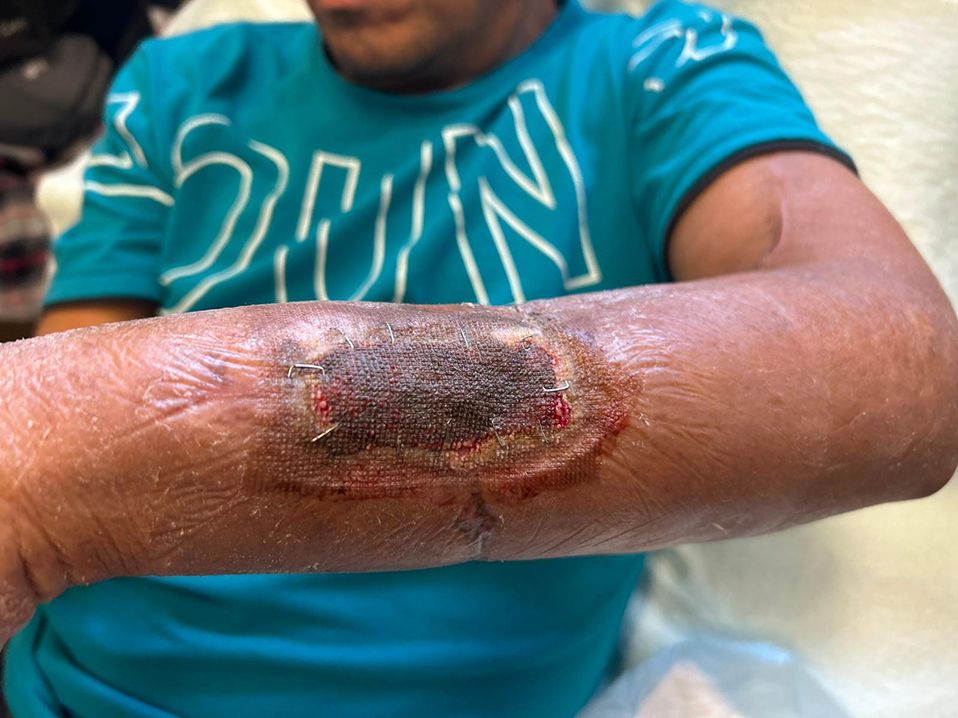 A migrant labourer had his arm shredded in a machinery accident on a farm near Oliver, B.C. It led to the lost of his job and months of rehabilitation and medical care.