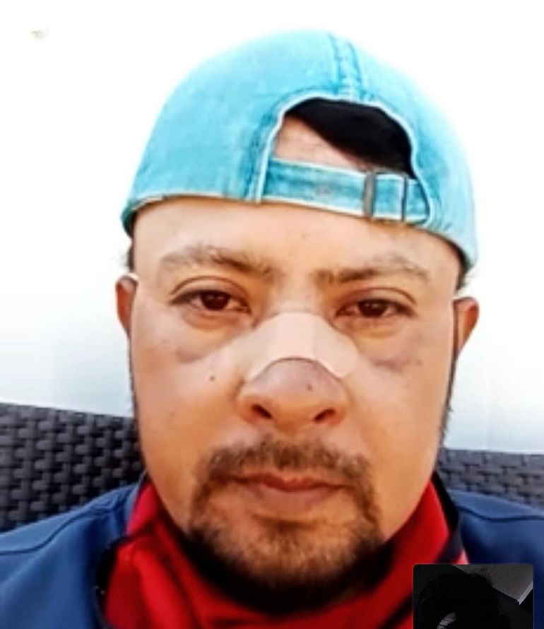 Jesus Chauteco, 44, was working in B.C. this summer when he flipped off an ATV without a helmet. He broke his nose.