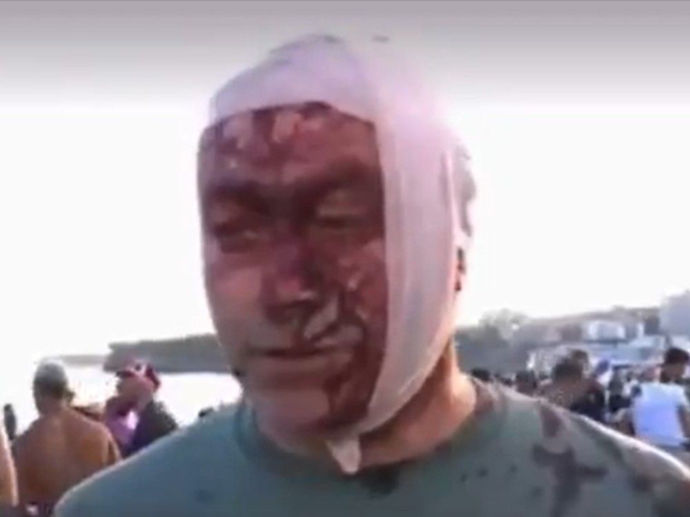 Human right lawyer Arsen Ostrovsky speaks to an Australian news station after he was injured during an attack on a Hannukah celebration on Bondi Beach on Sunday. Human right lawyer Arsen Ostrovsky speaks to an Australian news station after he was injured during an attack on a Hannukah celebration on Bondi Beach on Sunday.