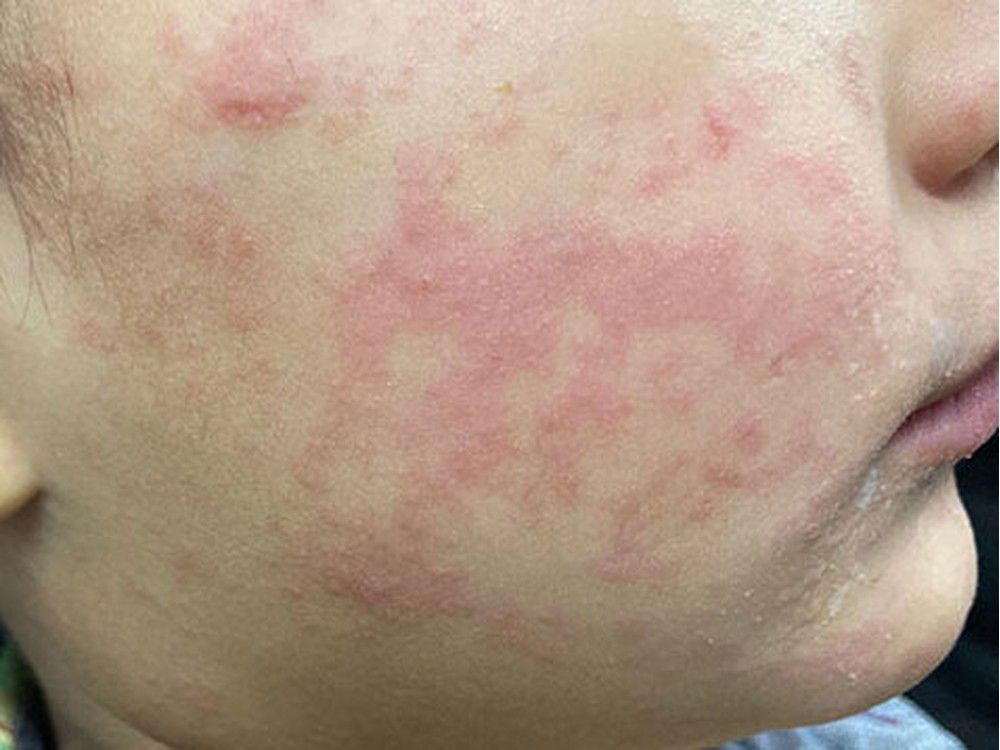 Measles cases surging across the U.S., spreading to five more states