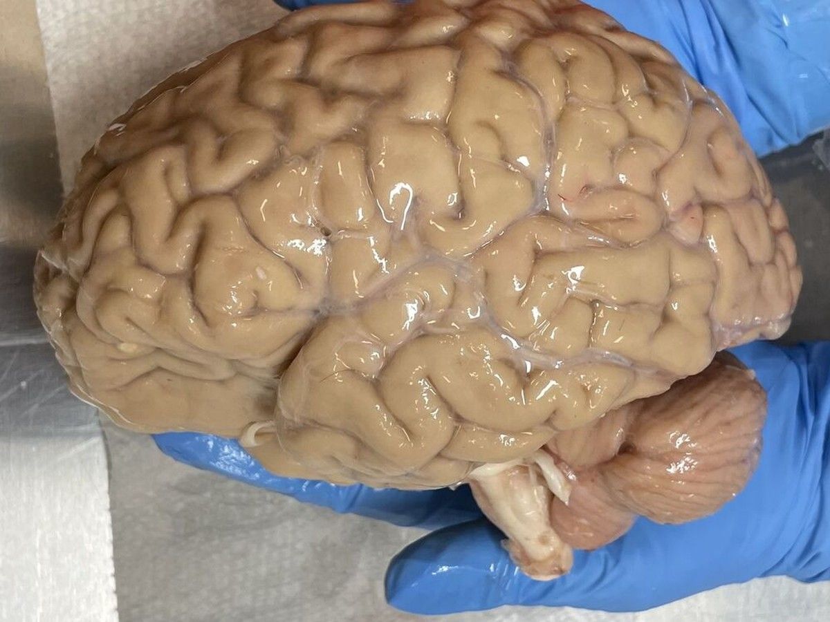 Doctors say there is a 25% chance a frozen brain or body could be revived in the future: survey