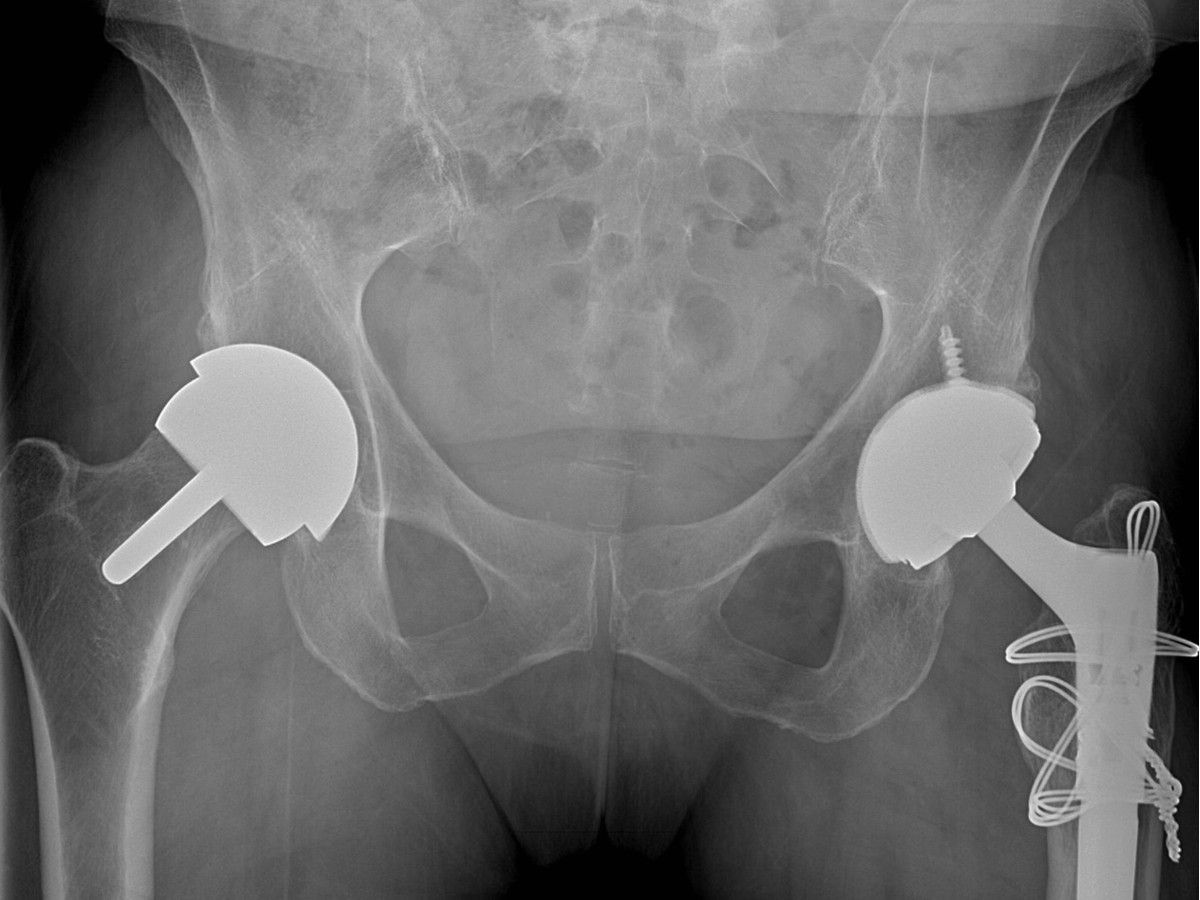  An X-ray image shows a patient who has had a hip resurfacing (left) and a hip replacement (right).