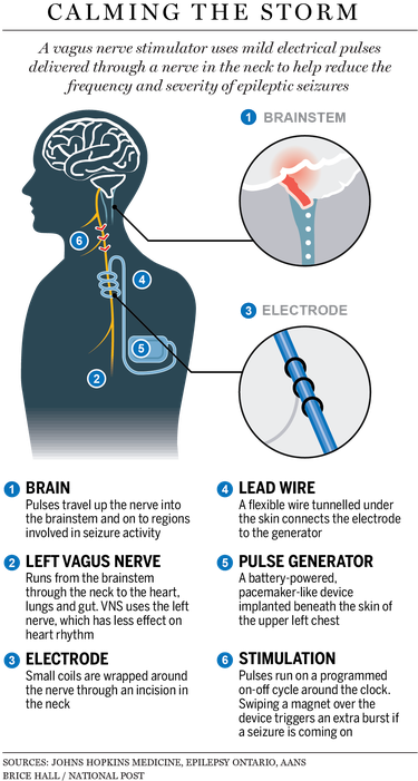 Illustration of vagus nerve stimulator.