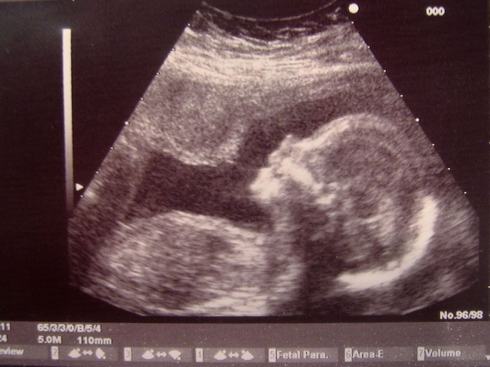 Ultrasound