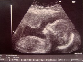Ultrasound