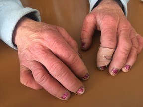 A homeless person's hands are red and swollen as a result of living out in the cold in this file photo.