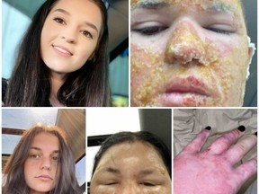 Photos of the two young women badly burned in the bonfire tragedy last month near Brinston, Cassandra Young in the top photos, and Jessica Goodenough in the bottom photos.Handout/Cornwall Standard-Freeholder/Postmedia Network

Handout Not For Resale