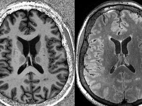 MRI brain scan