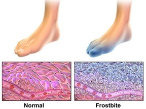 View of a normal foot and cells and a foot and cell damage with frostbite.