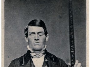 Phineas Gage experienced a traumatic brain injury when an iron rod was driven through his entire skull, destroying much of his frontal lobe.