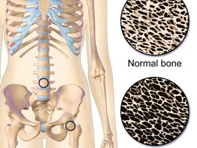Osteoporosis locations in the body. Top image shows healthy bone; bottom image shows osteoporosis.