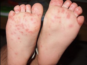 The rash of hand, foot,and mouth disease on soles of a child's feet.
