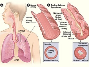 Figure A shows the location of the lungs and airways in the body. Figure B shows a cross-section of a normal airway. Figure C shows a cross-section of an airway during asthma symptoms.