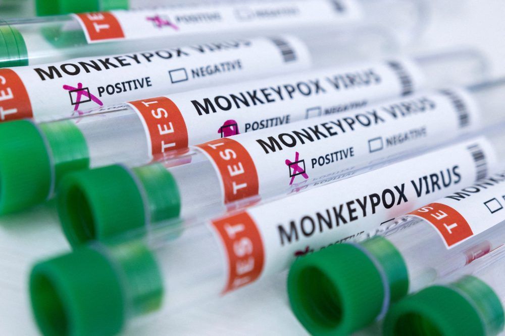 Public health confirms the first case of monkeypox in the Kingston area