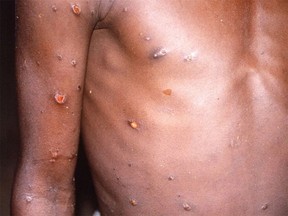 This file photo shows the arms and torso of a patient with skin lesions due to monkeypox. As of Thursday, there were 33 monkeypox cases in Ontario, 28 of which were in Toronto. The remainder were in Ottawa, Guelph, Halton and London. The virus was was first detected in monkeys and is mostly found in central and western Africa, but has more recently spread to other countries, including Canada.. (CDC/Brian W.J. Mahy/Handout via REUTERS)