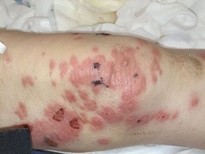 One of the less-graphic photos of what for months was Claude Gibeault's mystery rash.Handout/Cornwall Standard-Freeholder/Postmedia Network
