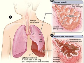 Figure A shows the location of the lungs and airways in the body, and also shows pneumonia affecting the lower lobe of the left lung. Figure B shows normal alveoli. Figure C shows infected alveoli.