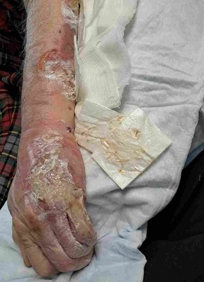 Frank Bruhmuller suffered severe burns when his arm was left hanging over his bed and resting on the baseboard heater at Extendicare York.