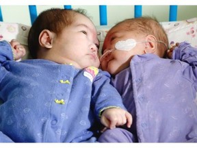 Twins, Mackayla, left, and Mackenzie cuddle after months of being treated apart at CHEO. The twins were born three months’ premature.