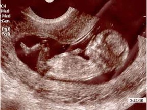 Showing pregnant women an ultrasound image of their unborn child, such as this 11-week-old-fetus, is an effective way to convince them to keep the baby, anti-abortion advocates say.
