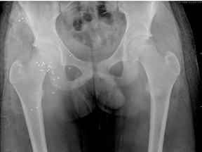 An X-ray shows the shotgun pellets embedded in a Florida boy's buttocks after a squirrel-hunting mishap.