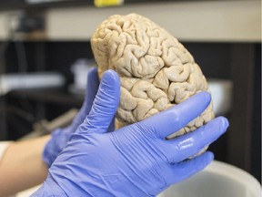 In this July 29, 2013 photo, a researcher holds a human brain in a laboratory at Northwestern University's cognitive neurology and Alzheimer's disease center in Chicago.