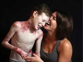 Jonathan Pitre, 14, has Dystrophic EB, which has left him without the "glue" that connects his top layers of skin. His entire body must be wrapped in gauze day and night to protect him from trauma and infection.