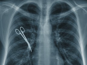 Local Input~ X-ray showing surgical instrument left in body after surgery.   Credit: Handout