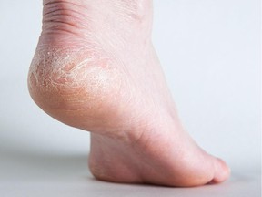 Emjoi Micro Pedi Man buffs away dry rough skin on your feet