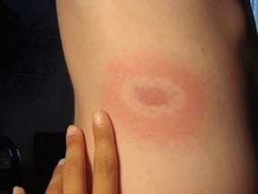 The characteristic 'bullseye rash' often found with Lyme disease infections.