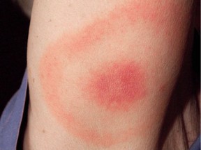 A rash in the pattern of a bulls-eye, which formed after a tick bite on this woman's right upper arm, who subsequently contracted Lyme disease.