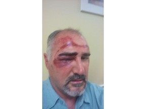 Calvin Stein's injuries can be seen in this 'selfie' he emailed to Postmedia after the incident.
