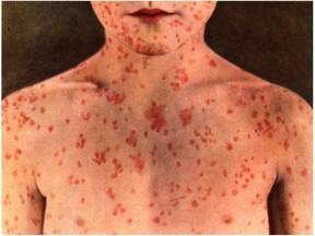 An archive image of a patient with a bad case of measles.