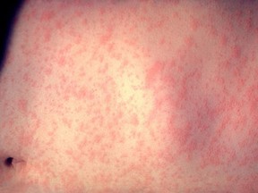 The rash-like symptom from the measles virus.