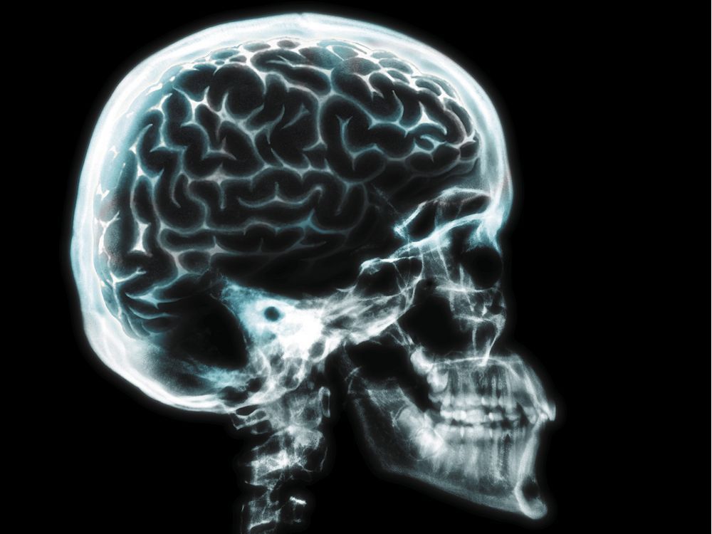 Brain damage visible long after concussion symptoms disappear, uOttawa ...