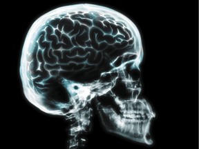 Brain damage from a concussion can linger for years after other symptoms have gone, according to new research at uOttawa.
