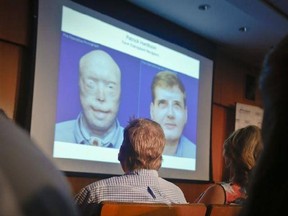 FILE - In this Wednesday, Aug. 24, 2016 file photo, former Mississippi firefighter Patrick Hardison, 42, center, views a video showing progression of his face transplant, during a press conference marking one year after his surgery, at New York University Langone Medical Center in New York. Hardison was disfigured while trying to save people from a house fire in 2001. Is replacing a severely disfigured person&#039;s face with one from a dead donor ready to be called regular care, something insurers s