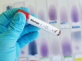 Blood sample with mumps virus positive