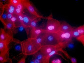 This undated fluorescence-colored microscope image made available by the National Institutes of Health in September 2016 shows a culture of human breast cancer cells. Environmental risks and heredity get the most blame for cancer, but new research released on Thursday, March 23, 2017 suggests random chance may play a bigger role than people realize: Healthy cells naturally make mistakes when they multiply, typos in your DNA that can leave new cells carrying cancer-prone genetic mutations. (Ewa K