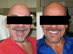 Yves Briand before and after his New-Teeth-in-a-Day procedure.