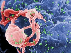 This undated photo provided by the Centers for Disease Control and Prevention shows a scanning electron micrograph of multiple round bumps of the HIV-1 virus on a cell surface. In a report released on Monday, July 24, 2017, researchers said a South African girl born with the AIDS virus has kept her infection suppressed for 8 1/2 years after stopping anti-HIV medicines _ more evidence that early treatment can occasionally cause a long remission that, if it lasts, would be a form of cure. (Cynthia