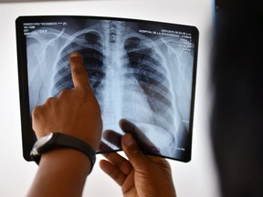 A doctor checks a lung x-ray.