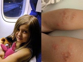 Bedbug bites are seen on seven-year-old Molly Reid's calves