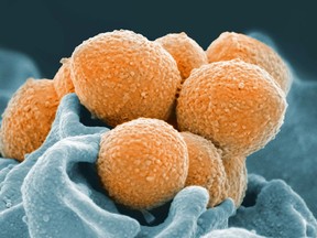 Image provided by the National Institute of Allergy and Infectious Diseases in the United States shows an electron microscope image of group A streptococcus (orange). The same bacteria that cause simple strep throat sometimes trigger bloodstream or even flesh-eating infections.