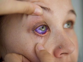 Catt Gallinger, who had a botched ink injection in her eyeball, shows the amount of swelling in her eye, at home in Ottawa on Friday, Sept. 29, 2017. THE CANADIAN PRESS/Justin Tang