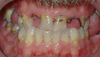 An example of a client’s teeth before the procedure.