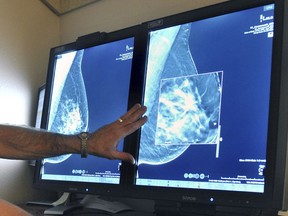 FILE - In this Tuesday, July 31, 2012 file photo, a radiologist compares an image from earlier, 2-D technology mammogram to the new 3-D Digital Breast Tomosynthesis mammography in Wichita Falls, Texas. The technology can detect much smaller cancers earlier. A study released Wednesday, Oct. 12, 2016 questions the value of mammograms for breast cancer screening. It concludes that a woman is more likely to be diagnosed with a tumor that is not destined to become large, and presumably more life-threatening, than she is to have earlier detection of one that is. (Torin Halsey/Times Record News via AP) ORG XMIT: TXWIC501