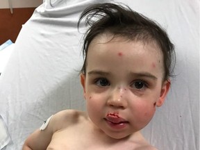 Hugo Giroux, two, after being attacked by a dog.