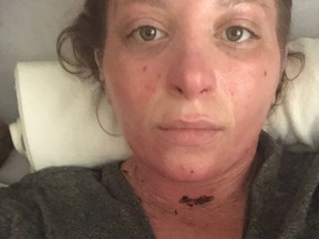 Hana Engel post-coma as she recovers from second and third degree burns to 35 per cent of her body.